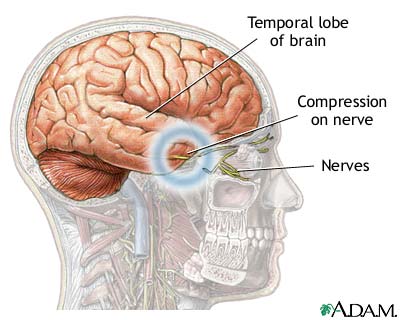Brain hernia