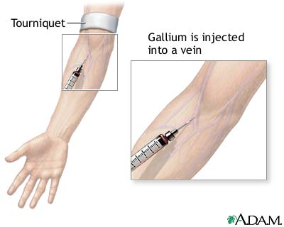 Gallium injection