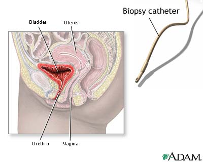 Ureteral biopsy
