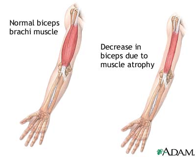 Muscular atrophy