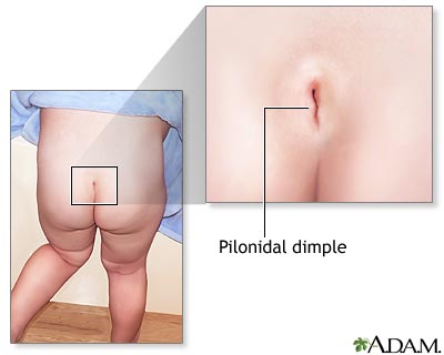 Pilonidal cyst and dimple