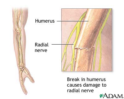 Radial nerve dysfunction