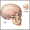 Craniotomy - series