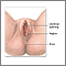 Anterior vaginal wall repair (Surgical treatment of urinary incontinence) - series