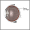 Retinal detachment repair - series