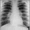 Sarcoid, stage I - chest X-ray