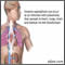 Pulmonary aspergillosis