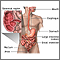 Crohn's disease - affected areas