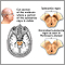 Substantia nigra and Parkinson's disease