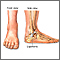 Ankle sprain - series
