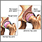 Arthritis in hip