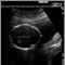 Ultrasound, normal fetus - head measurements