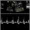 Ultrasound, normal fetus - heartbeat