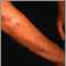 Lichen planus on the arm
