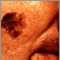 Skin cancer, close-up of lentigo maligna melanoma