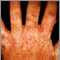 Porphyria cutanea tarda on the hands