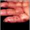 Dermatitis, herpetiformis on the hand
