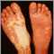 Sturge-Weber syndrome - soles of feet