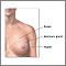 Breast lump removal - series
