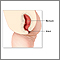 Imperforate anus repair  - series
