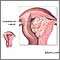 Endometrial cancer