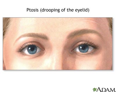 Ptosis, drooping of the eyelid