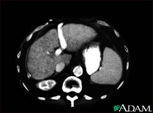 Liver cirrhosis, CT scan