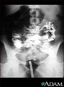 Volvulus - X-ray