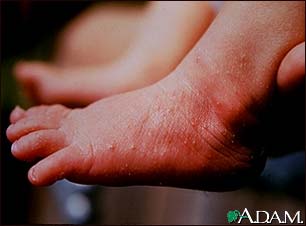 Erythema toxicum on the foot