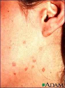 Warts, flat on the cheek and neck