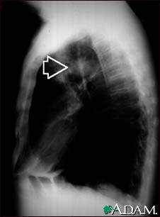 Pulmonary mass - side view chest X-ray