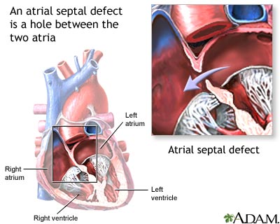 Atrial septal defect