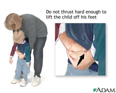 Heimlich maneuver on conscious child