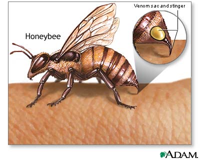 Insect stings and allergy
