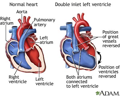 Double inlet left ventricle
