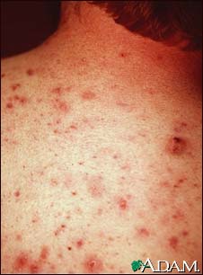 Acne, vulgaris on the back