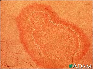 Erythema annulare centrifugum - close-up