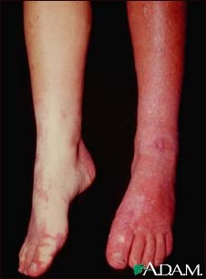 Sturge-Weber syndrome - legs