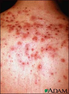 Acne, close-up of cysts on the back