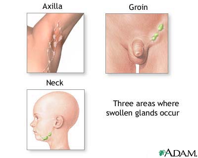 Swollen glands