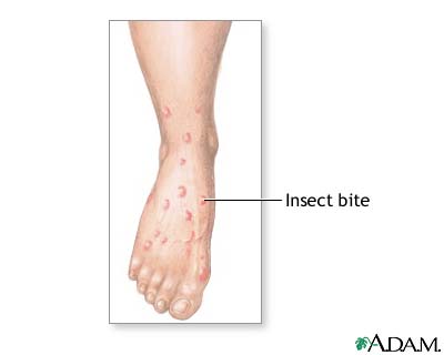 Insect bites and stings