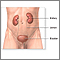 Kidney removal - series