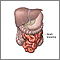Meckel's diverticulectomy  - series