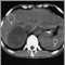 Adrenal Tumor - CT