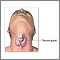 Thyroidectomy - series