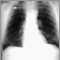 Pulmonary nodule - front view chest X-ray