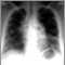 Sarcoid, stage IV - chest X-ray