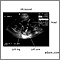 Ultrasound, normal fetus- ventricles of brain