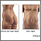 Liposuction - series