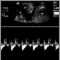 Ultrasound, normal fetus - heartbeat